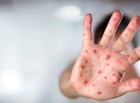 Ülkeyi kızamık kabusu sardı! 779 çocuk hayatını kaybetti